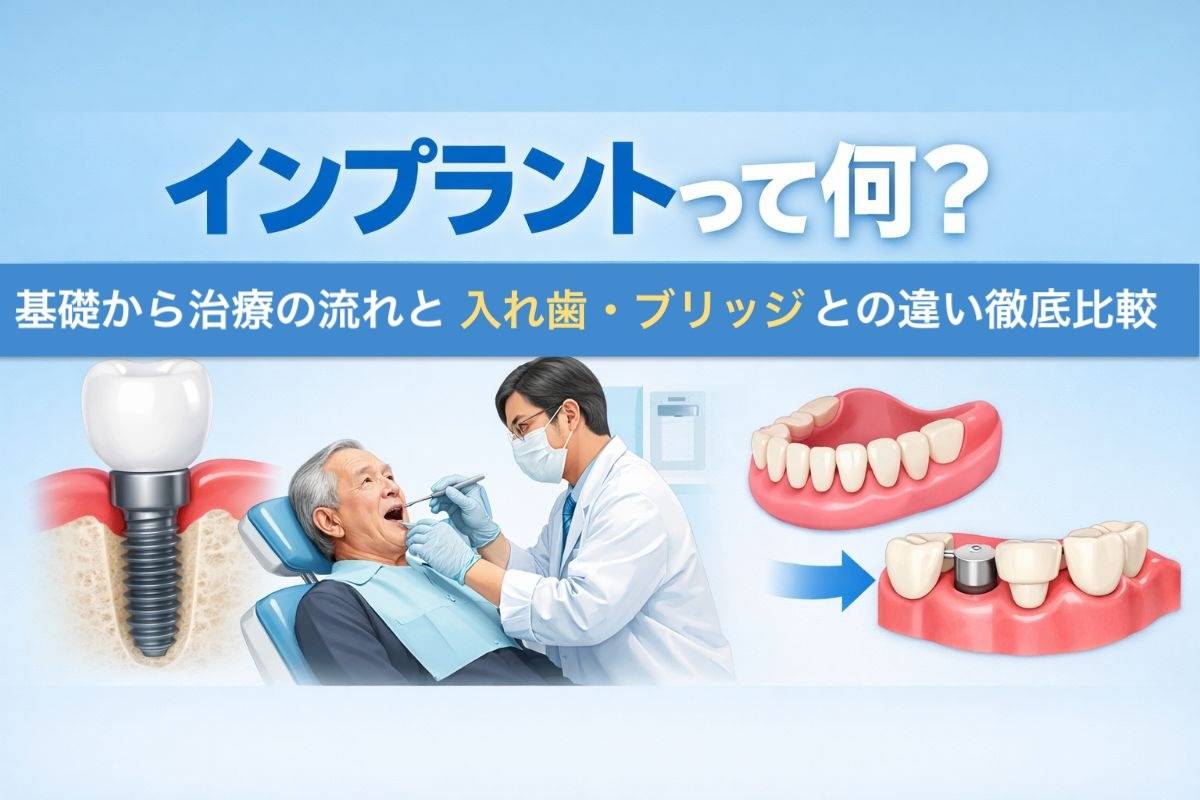 インプラントって何?基礎から治療の流れと入れ歯・ブリッジとの違い徹底比較